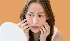 Da mỏng lộ mao mạch phải làm sao?