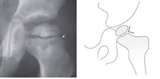 Image result for Perthes Test