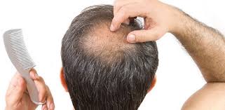 It is therefore recommended to avoid brushing wet hair. How To Stop Hair Loss In Men Hair Transplant Clinicexpert