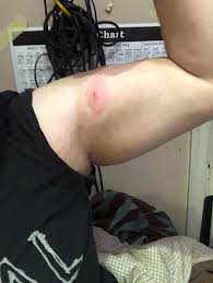 Image result for wolf spider bite skin
