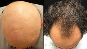 There is no set age for hair loss or growth. Drug Reverses One Baldness Type Is Male Pattern Next Cnn
