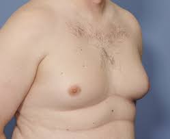 For men, the lifetime risk of being diagnosed with breast cancer is about 1 in 833. Breast Cancer In Men Lack Of Awareness Leads To Late Diagnosis Explore Plastic Surgery