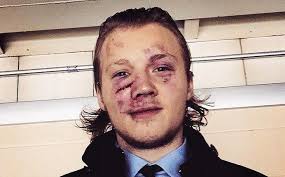 Hockey player's face looks gruesome after taking a puck to the face