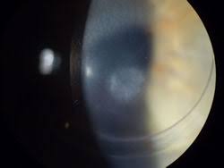 Corneal Haze Post Photorefractive Keratectomy - Sciencedirect