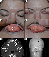 Image result for milium cyst on eyelid