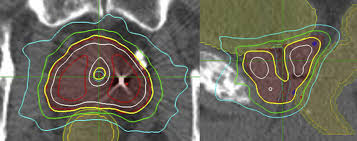 Advanced prostate cancers may cause many. Retreatment For Local Recurrence Of Prostatic Carcinoma After Prior Therapeutic Irradiation Efficacy And Toxicity Of Hdr Like Sbrt International Journal Of Radiation Oncology Biology Physics
