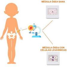 Es importante que sepa que la la leucemia se denomina linfocítica o linfoblástica si el cambio canceroso se produce en un. La Leucemia Linfoblastica Aguda Lla En Ninos Ocronos Editorial Cientifico Tecnica