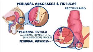 Image result for Ischiorectal Abscess