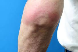 5,861 likes · 3 talking about this. Gout Attack Dijelaskan Punca Gejala Dan Kekerapan