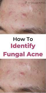 Do you have little itchy bumps that never seem to go away? 30 Fungal Acne Ideen Akne Pilze Hautpflege Akne