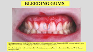 Look up any word in the dictionary offline, anytime, anywhere with the oxford advanced learner's. Periodontitis Gingivitis Meaning Symptoms Tx Gum Disease
