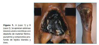 Mucormicosis Cutanea Primaria A Proposito De Dos Casos Revision De La Literatura