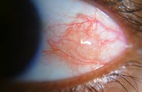 Image result for lesion sclera