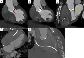 Can you have an mri with a pacemaker. Magnetic Resonance Imaging In A Patient With Temporary External Pacemaker Heartrhythm Case Reports