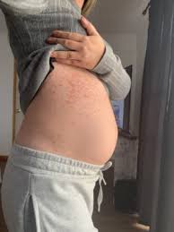 Sarpullido Alergia Alimentaria Club De Bebes Septiembre 2020 Babycenter