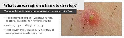 Ingrown hairs on the legs can signal that a person is using the wrong type of razor. Can Laser Hair Removal Work For Ingrown Hairs Urbana