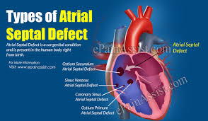 Types of Atrial Septal Defect: It's Causes, Symptoms & Treatment