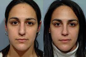 Be part of something exceptional. Do I Need Septoplasty Or Rhinoplasty Pearlman Aesthetic Surgery