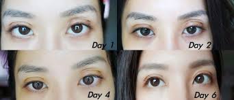 Non Incisional Double Eyelid Surgery Cambridge Medical Group