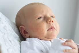 Les filles, on a toutes (ou presque) un ou deux boutons qui font leur entrée remarquée dans notre visage lors de cette fameuse période du mois. Eczema De Bebe Causes Et Traitements