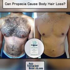 So do the benefits outweigh the risks? Can Propecia Cause Body Hair Loss Body Hair Loss Body Hair Hair Loss