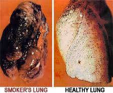 Image result for lungs before and after smoking
