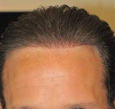 Biofibre Artificial Hair Implant Exoderm Medical Centers