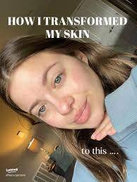 Transform Your Skin: My Journey to Healthy Skin with an Esthetician