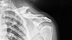Image result for Fracture Complication