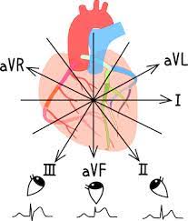 心筋梗塞部位からみる心電図変 見て わかる 病態生理と看護 花子のまとめノート 心筋梗塞 看護ノート 循環器系