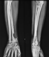 Image result for Osteomyelitis