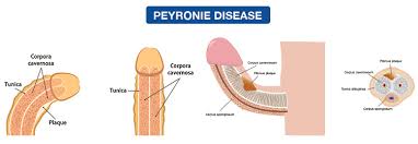 Penile Natural Curvature Correction Loria Medical 786 409 5911