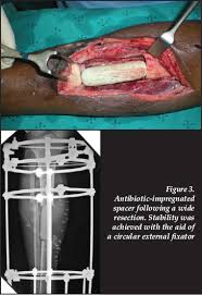 Image result for Osteomyelitis Management