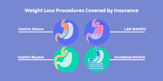 This weight loss surgery is an option for people that aren't eligible or don't qualify for other bariatric procedures. Weight Loss Surgery Insurance Secrets Revised List