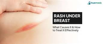 Image result for Candidiasis under breasts