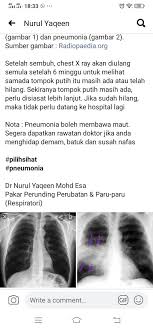 Kenali 5 jenis penyakit membunuh rakyat malaysia dan bagaimana kita boleh hindari. Dr Nurul Yaqeen On Twitter Pneumonia Seriouskah Jangkitan Kuman Di Paru Paru Jika Anda Dijangkiti Kuman Di Paru Paru Adakah Anda Perlu Masuk Wad Atau Icu Atau Duduk Di Rumah Sahaja