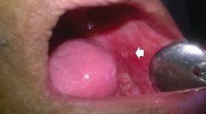 Image result for Erythroplakia roof of mouth