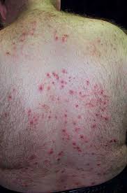 Image result for Neurotic Excoriation