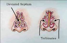 A deviated septum may cause congestion, problems with breathing, or nasal discharge. Septoplasty Deviated Septum Surgery California Surgical Institute