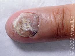 Image result for Paronychia feet