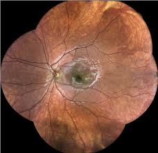 Pourquoi faire un fond d'œil ? Pathologies Oculaires Centre Ophtalmologique Rabelais