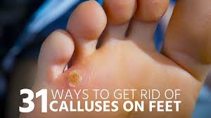 31 Ways To Get Rid Of Calluses On Feet Foot Callus Corn Feet Hard Skin On Feet