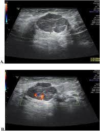 The use of ultrasound for breast cancer screening. Ultrasound Lexicon In Diagnosis And Management Of Breast Fibroadenoma When To Follow Up And When To Biopsy Egyptian Journal Of Radiology And Nuclear Medicine Full Text