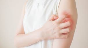 أبرز أنواع الفطريات الجلدية الشائعة ويب طب