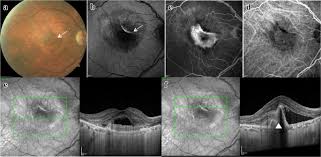 Aug 28, 2020 · after sealing a retinal tear with cryopexy, a gas bubble is injected into the vitreous. Spontaneous Retinal Pigment Epithelial Tear In Type 2 Choroidal Neovascularization Repair Mechanisms Following Anti Vegf Therapy International Journal Of Retina And Vitreous Full Text