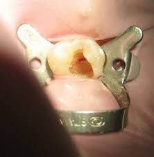 How long do they take? Root Canal Treatment Wikipedia