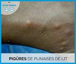 Traitement bouton punaise de lit. Punaises De Lit Et Traitement De La Peau Docteur Nuisibles