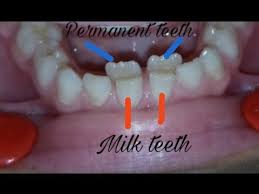 Check spelling or type a new query. Over Retained Deciduous Teeth Milk Teeth Extraction Dental Issues Youtube
