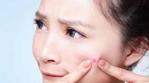 Berikut adalah 10 cara terbaik untuk hilangkan jerawat dengan cepat tanpa kesan sampingan. 5 Cara Cepat Hilangkan Jerawat Hanya Dalam Semalam Bangka Pos