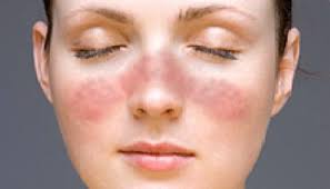 Antiphospholipid antibody syndrome